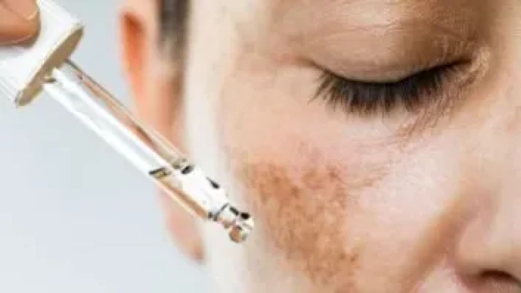 وصفات طبيعية سهلة للتخلص من البقع الداكنة الناتجة عن حب الشباب